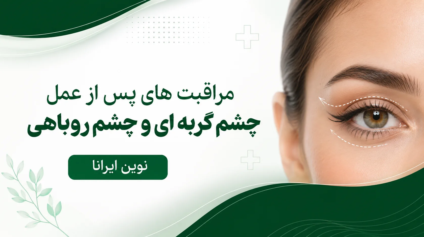 مراقبت های پس از عمل چشم گربه ای و چشم روباهی